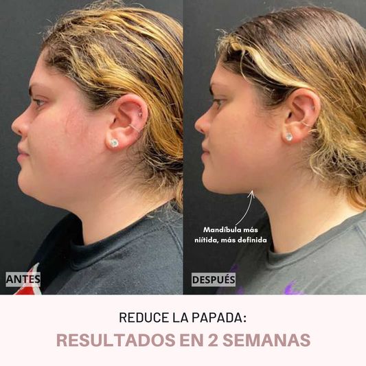 ¡Reductor de papada en tan solo 2 semanas con el dispositivo V-Face!